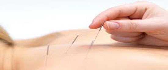 acupuncture